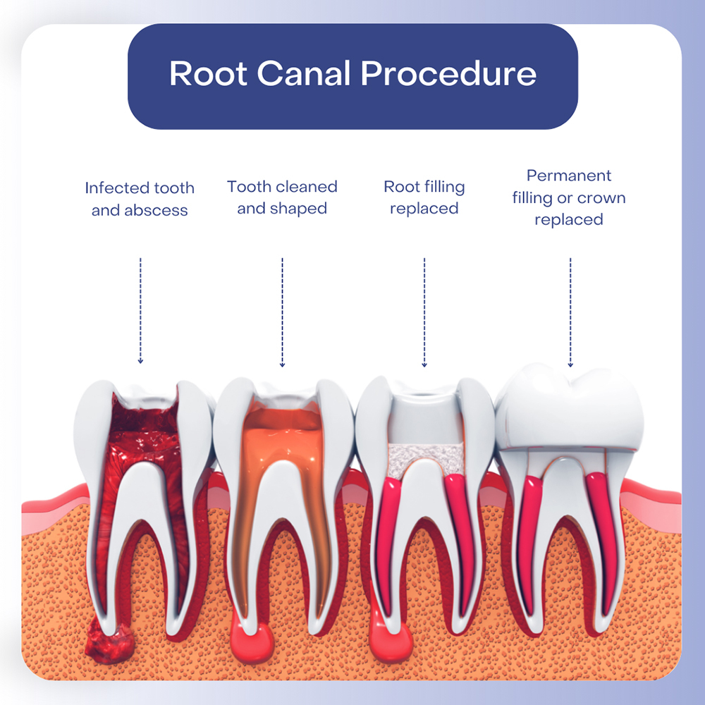 infected root canal