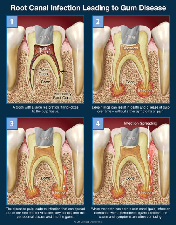 root canal